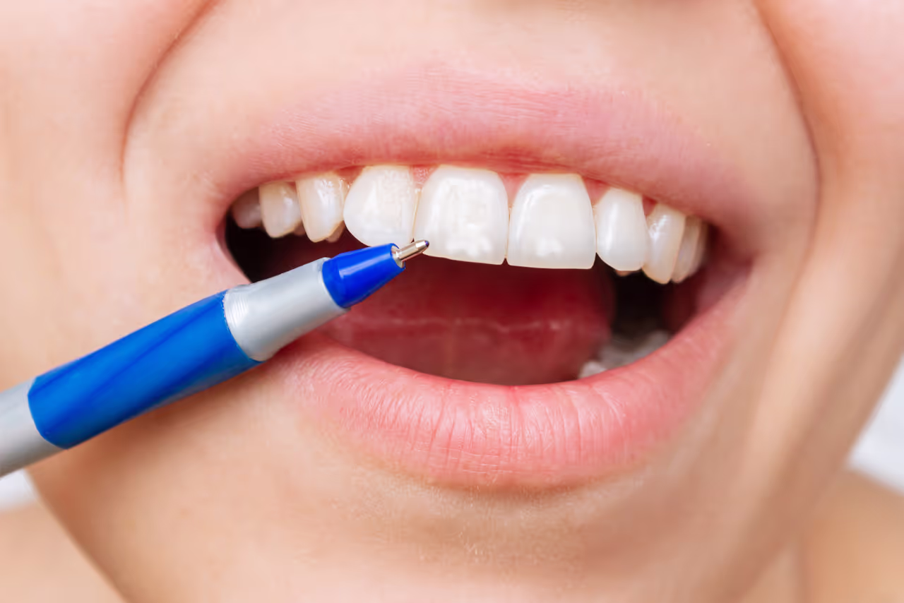 The Basics of Enamel Hypoplasia